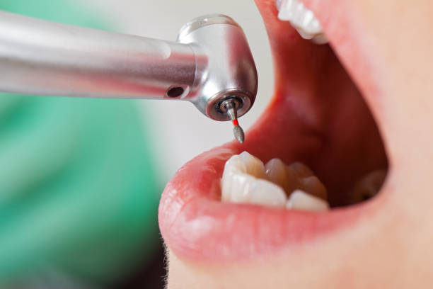 Best Knocked-Out Tooth (Avulsed Tooth) Treatment in Kewanee, IL